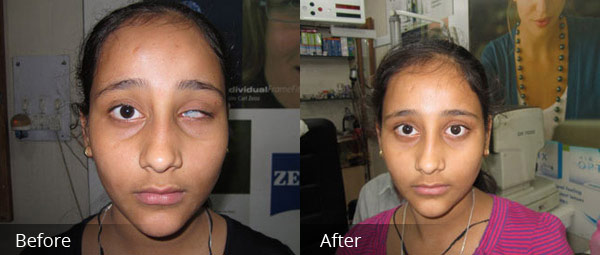 Artificial Eye Centre In Delhi, India