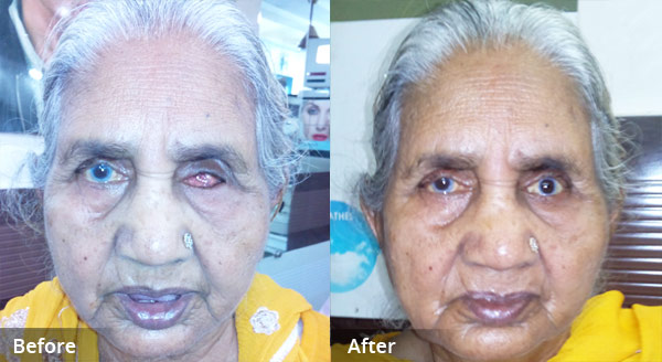 Ocular Prosthesis, Ocular Prosthesis In Delhi, Ocular Prosthesis In India,  custom made ocular prosthesis