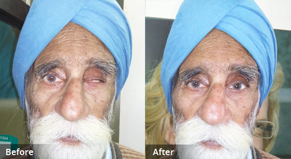 Ocular Prosthesis, Ocular Prosthesis In Delhi, Ocular Prosthesis In India, custom made ocular prosthesis