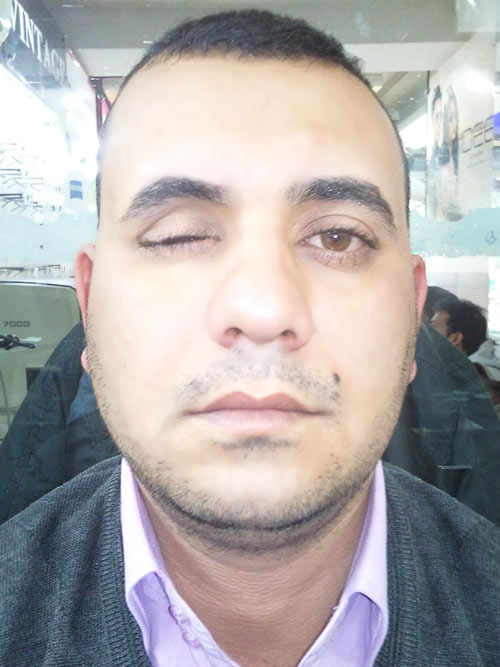 Motility Coupling Post, Artificial Eye Centre In Delhi, Best Ocularist in delhi