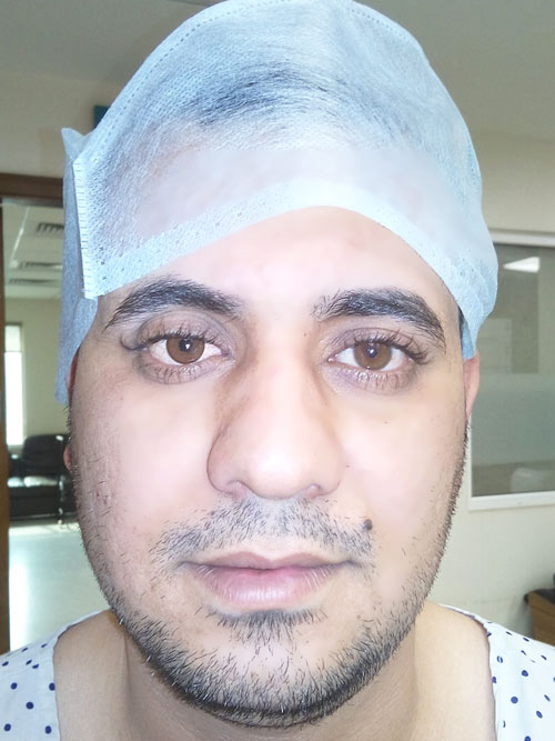 Motility Coupling Post, Artificial Eye Centre In Delhi, Best Ocularist in delhi