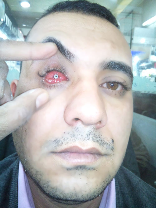 Motility Coupling Post, Artificial Eye Centre In Delhi, Best Ocularist in delhi