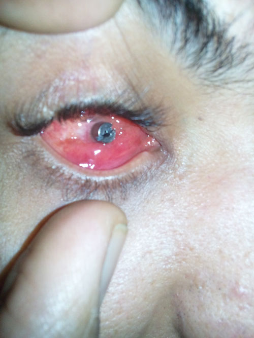 Motility Coupling Post, Artificial Eye Centre In Delhi, Best Ocularist in delhi