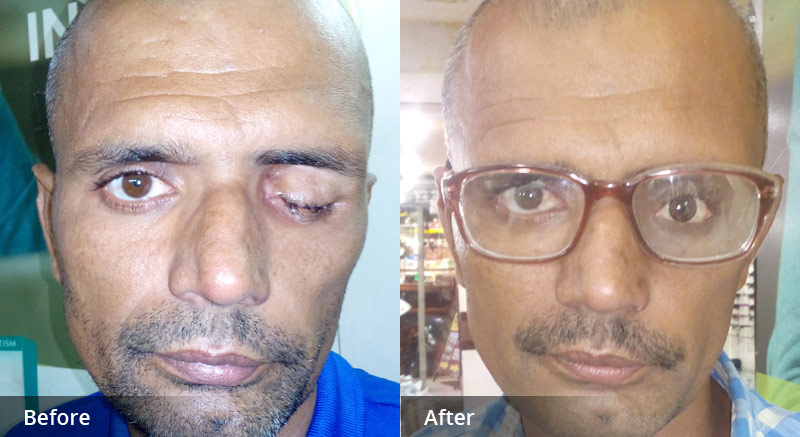 Orbital Prosthesis In Delhi