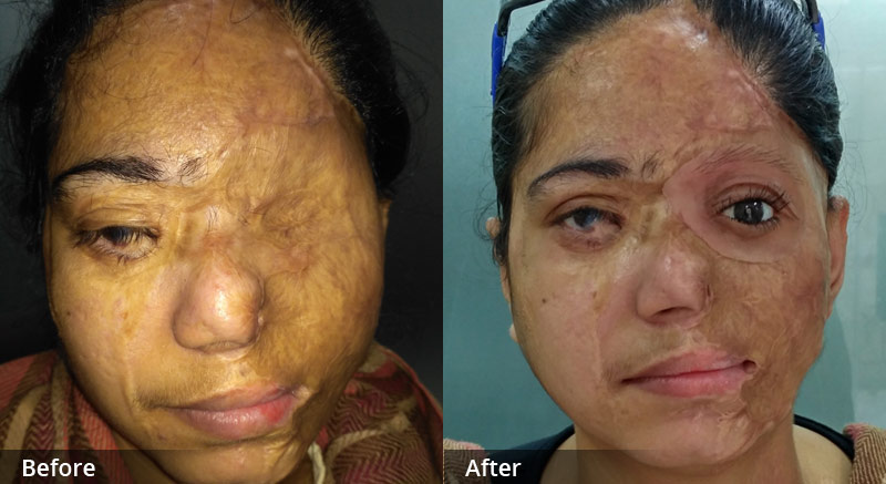 OOrbital Prosthesis In Delhi