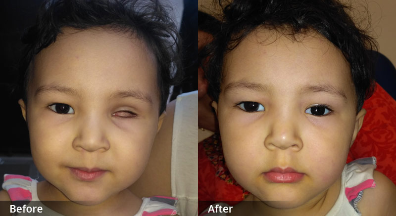 Retinoblastoma - Artificial eye centre in delhi, India